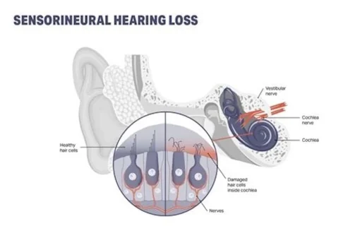 hearing-aids-simpsonville-sc-sound-hearing-6-8-2026-7
